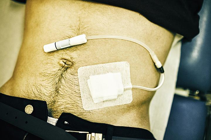 Historie sukcesu pacjentów dializowanych w domu